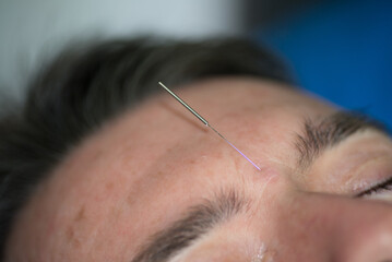Acupuncture methods