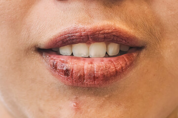 Dry bleeding cracked or chapped lips. Cracked young female lips. Dermatillomania skin picking....