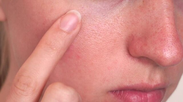 Extreme close-up of cheek and nose area showing natural skin with redness, pores, and subtle texture. Ideal for dermatology, skincare results, cosmetic treatment visuals or educational purposes.
