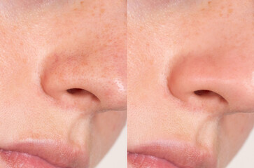Side-by-side macro photo shows visible pore reduction and smoother texture on a woman’s nose and...