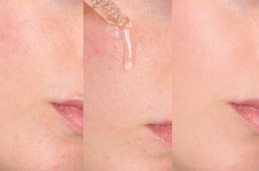 Three-frame collage showing facial skin improvement with serum. From visible pores to smooth...