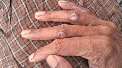 Fototapeta premium injured and peeled fingers on a brown skin man hand