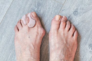 Close-up of feet with hallux valgus deformity, one foot wearing silicone toe separators on wooden floor, concept of health and orthopedic care