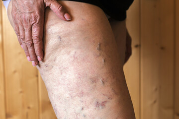 Close-up of a senior woman's leg affected by varicose veins and spider veins, hand gently resting on skin, concept of aging, vein health and circulatory problems