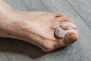 Close-up of a human foot with hallux valgus and silicone orthopedic toe corrector on wooden floor, concept of foot deformity treatment and podiatry care