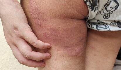 Portrait the rash hives allergy and inflammation skin, reaction and urticaria, infection and itchy, sensitive and symptom, scar and atopic on the legs of the woman, health care and medical concept.