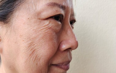 portrait the wrinkles and scar, Flabbiness and Flabby skin beside the eyelid, swelling and ptosis...