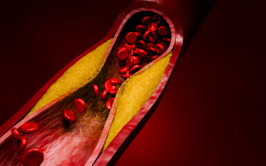 Vascular damage, artery clogging, and plaque buildup from junk food, high sugar consumption, processed foods, alcohol abuse, and poor lifestyle choices affecting heart health. 3D Rendering