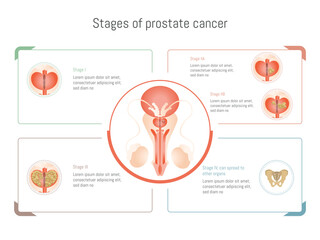 Prostate cancer stages infographic showing tumor growth