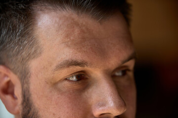 Inclusive beauty. Man with visible skin features, birthmark, looks calmly away from camera. Concept...