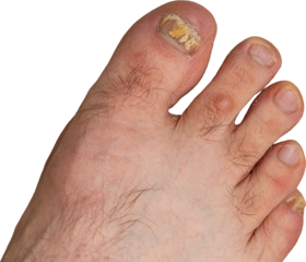 Feet of a man close-up of fingers affected by a fungal nail plate. Ugly toes.