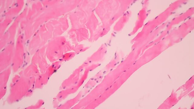 View in microscopic of glandular epithelial cell, adenonocarcinoma from human lung cancer, tissue section by H and E stain.Pathology diagnosis.Medical concept. Under microscope, magnification 600X