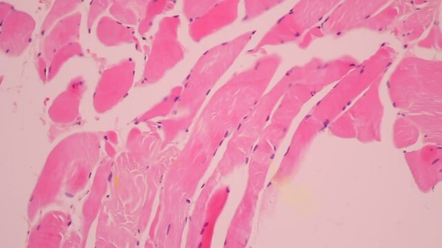 View in microscopic of glandular epithelial cell, adenonocarcinoma from human lung cancer, tissue section by H and E stain.Pathology diagnosis.Medical concept. Under microscope, magnification 600X