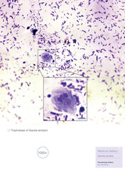 Giardia is a parasitic disease caused by Giardia duodenalis. Patients have diarrhea, abdominal pain and weight loss.Magnify 1000x.
