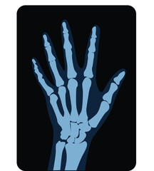 Osteoarthritis image. x ray image of the hand