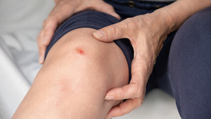 Fresh wound on knee after fall. Knee injury. Older woman examining knee wound. Type of superficial skin wound - abrasion or scratch. Concept of danger of falling and getting injured in old age.