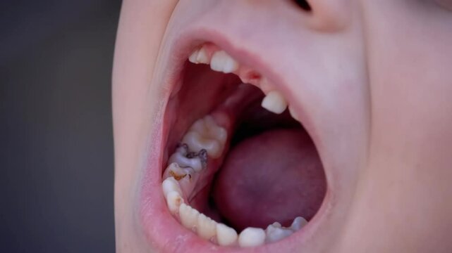 A child has lost a baby tooth. Kid.Concept baby tooth