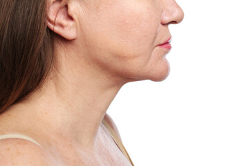 Obraz premium Woman before cosmetic procedure on white background, closeup