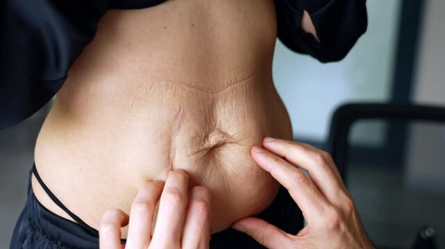 Loose wrinkled extra skin on the belly of unrecognized woman. Male hands check the area for future plastic surgery.