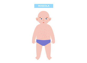 Roseola or exanthem subitum