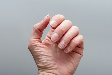 Detailed close-up of a hand showing brittle, dry, and peeling nails, with dehydrated skin....