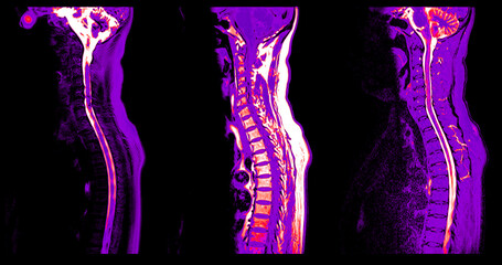 The MRI scan of the cervical spine shows detailed imaging of the vertebrae and spinal cord, highlighted in vibrant pink. The clear delineation of the spinal cord and vertebral structures is evident.