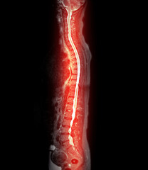 MRI whole spine screening for diagnosis spinal cord compression.
