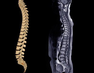 MRI whole spine screening for diagnosis spinal cord compression.