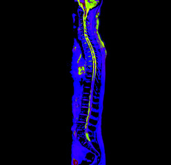 MRI whole spine screening for diagnosis spinal cord compression.