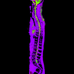 MRI whole spine screening for diagnosis spinal cord compression.