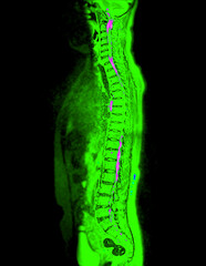 MRI whole spine screening for diagnosis spinal cord compression.