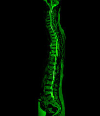 MRI whole spine screening for diagnosis spinal cord compression.