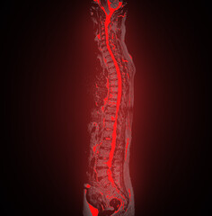 MRI whole spine screening for diagnosis spinal cord compression.