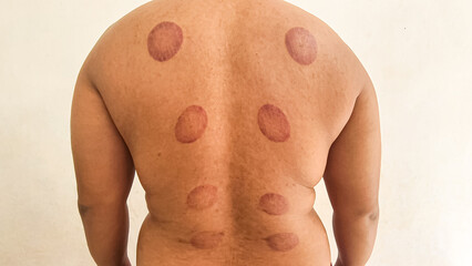 Close-up view of a person's back after undergoing cupping therapy treatment session