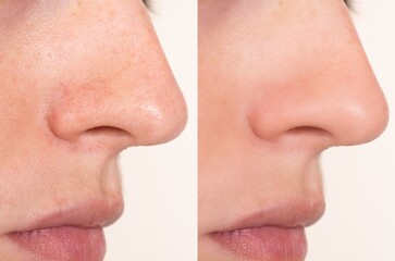Obraz premium Close-up comparison of nose and cheek skin before and after pore-minimizing skincare routine. Ideal for dermatology, beauty, or cosmetic product marketing