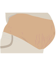 stretch marks on pregnant women's stomachs