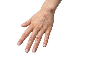 Eczema Affected Human Hand Isolated on White Background, A Case of Dermatitis  characterized by...