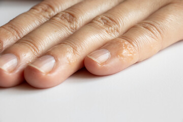 Finger with rash and skin irritation from allergies on a girl's hand