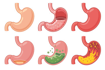 Obraz premium Medical Illustration Six Stages of Stomach Conditions