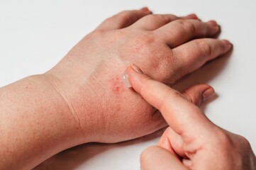A person applies cream to irritated skin on their hand, indicative of a skin condition.