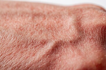 Close-up of dry, flaky skin on a hand, showing texture and condition.