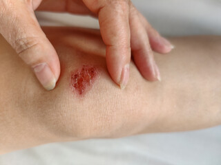 Wound on knee of slender young woman. Healing of skin lesion after fall. Examination of skin...