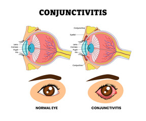 Conjuctivitis or Pink Eye Inflammation or Infection, Eye Vision Problem, Eye Disease for Educational Medical Poster Design Healthcare Scheme, Eye Illness and Eyesight Problem,  Medical Retina Health.