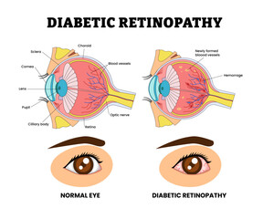 Diabetic Retinopathy Eye Vision Problem, Eye Disease for Educational Medical Poster Design Healthcare Scheme, Eye Illness and Eyesight Problem, Medical Retina Health, Diabetes Complication, Hemorrhage