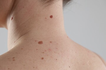 Woman with moles on her body against light background, closeup