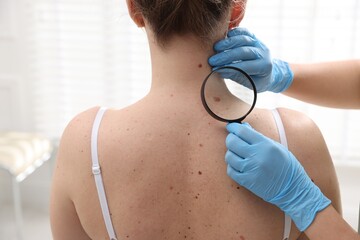 Doctor examining woman's moles in hospital, closeup