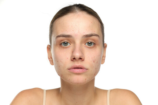 Young woman with acne and bare skin looking at camera, skincare concept, studio shot on white background