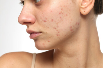 Studio closeup of young woman with acne on cheek and jawline, skincare concept, white background.