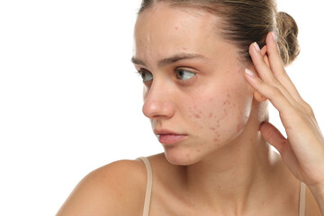 Studio shot of young woman touching face with acne, skincare concept on white background.
