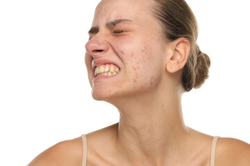 Studio shot of young woman with acne clenching teeth in frustration, bare skin on white background.